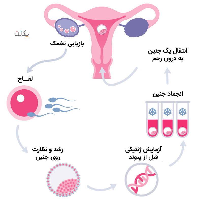مرحله به مرحله آی وی اف