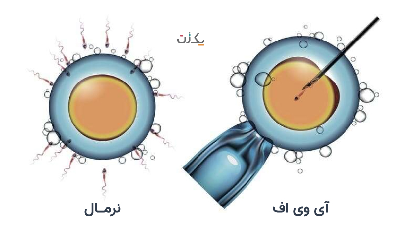 آی وی اف چیست