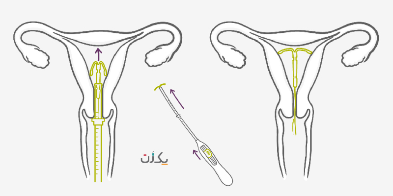نحوه گذاشتن آی یودی