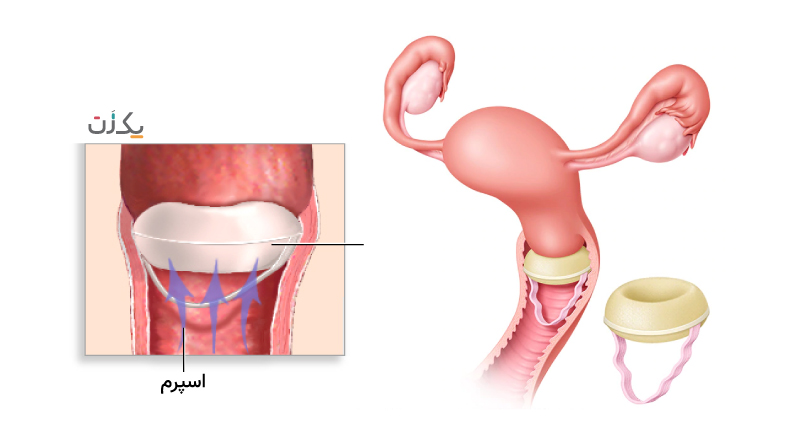 مشکلات اسفنج ضد بارداری