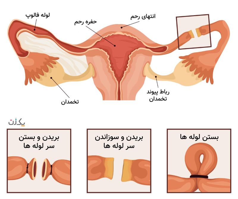 بستن لوله رحم (توبکتومی) چیست؟