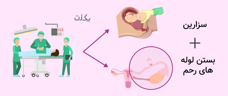 بستن لوله رحم بعد از سزارین