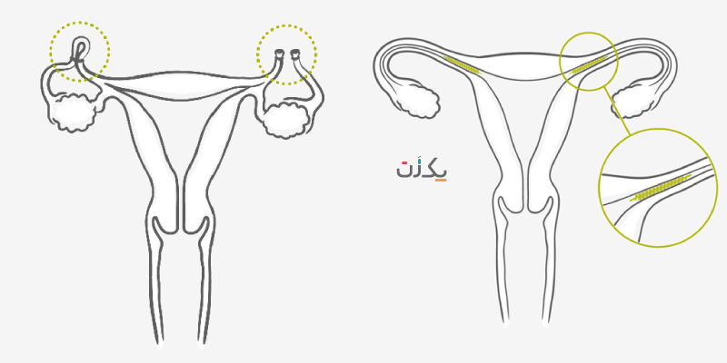 امکان بارداری بعد از توبکتومی بسیار کم است