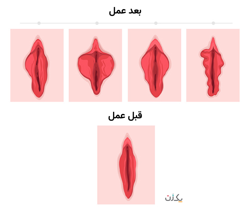 عکس های عمل لابیاپلاستی