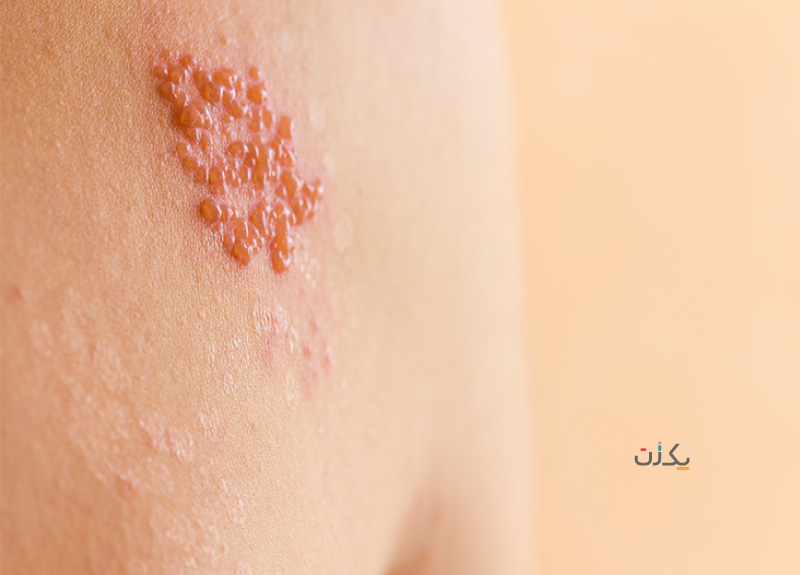 شکل ظاهری تبخال تناسلی