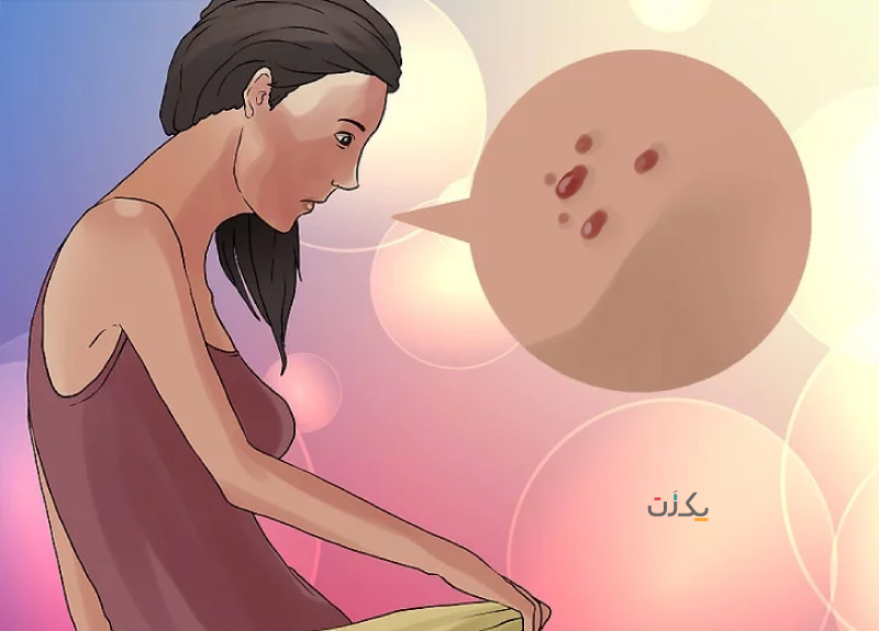 ویروس hpv  - زگیل تناسلی