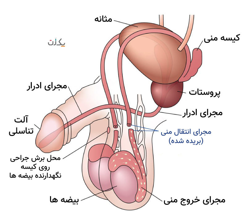 وازکتومی موقتی نیست و روش دائم جلوگیری از بارداری است