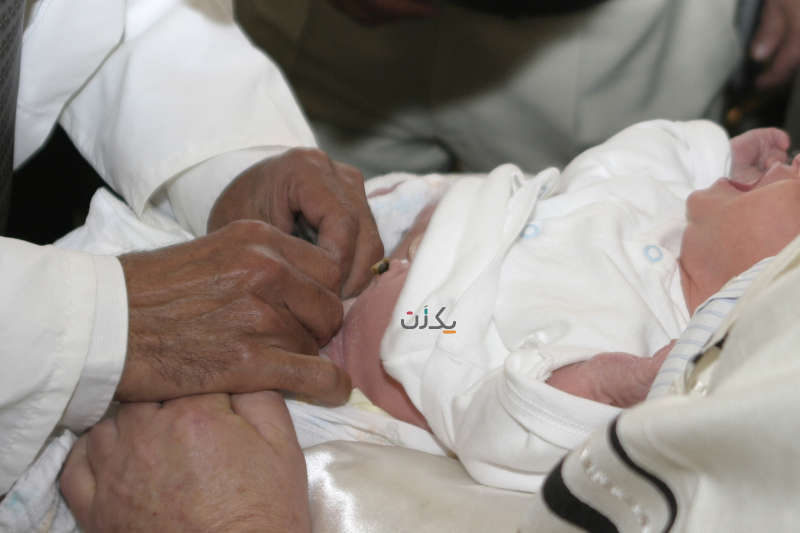 ختنه نوزاد - ختنه با حلقه