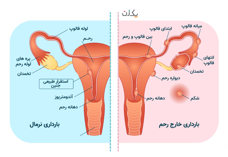 عکس بارداری خارج از رحم