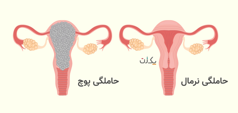 بارداری پوچ چیست؟