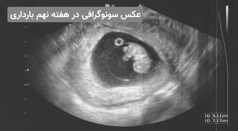 عکس سونوگرافی جنین در هفته نهم بارداری