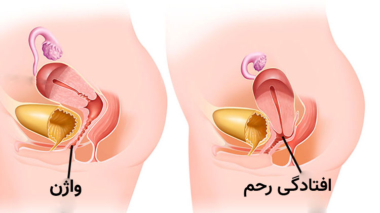 از کجا بفهمم واژنم تنگه یا گشاد؟