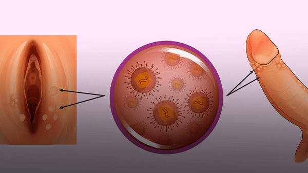 ویروس hpv عامل زگیل تناسلی