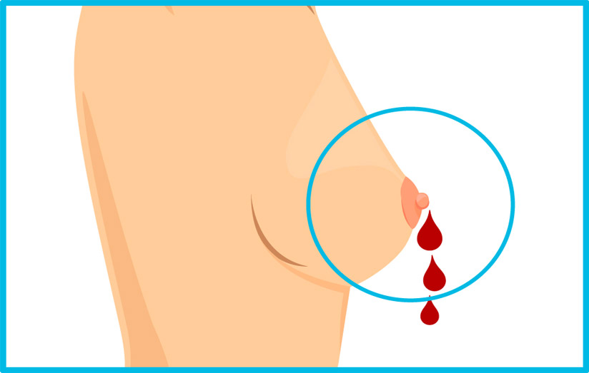 انواع ترشحات نوک سینه