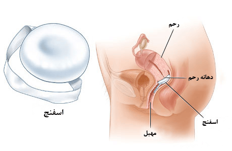 اسفنج ضدبارداری چیست؟